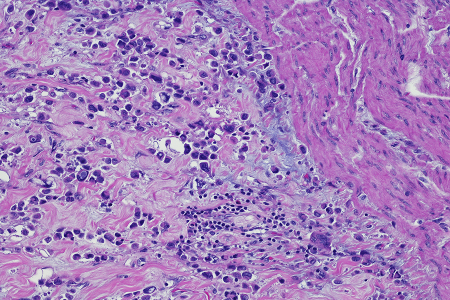 Plasmacytoid variant of urothelial carcinoma