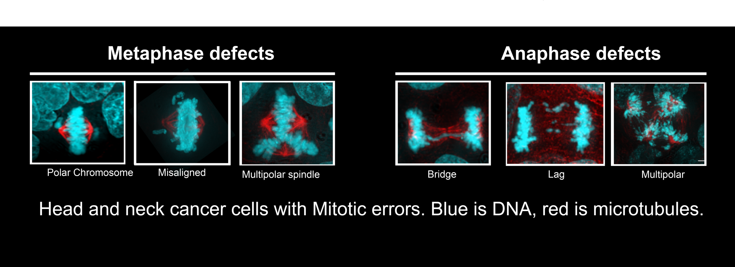 Cosper Lab Research Figure 2. Micrographs of Head and neck cancer cells with mitotic errors.