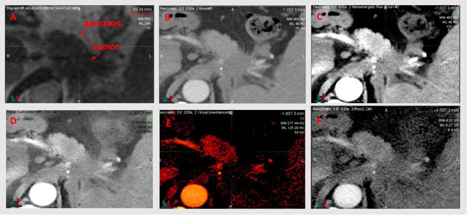 pancreatic tumor scan
