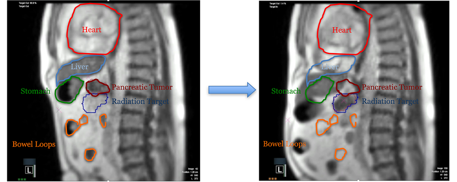 MRI guided Radiotherapy scan with organ overlay