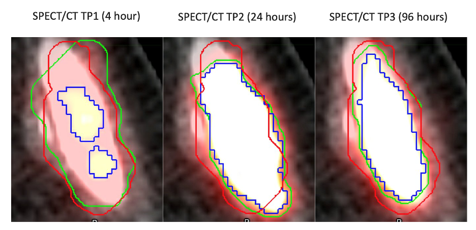 tumor segmentation