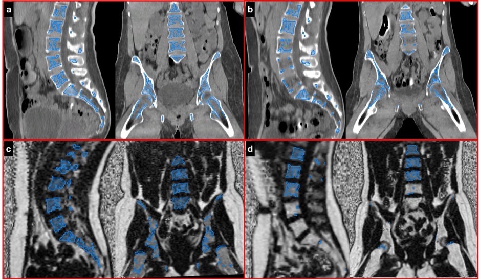 bone marrow contours CT image