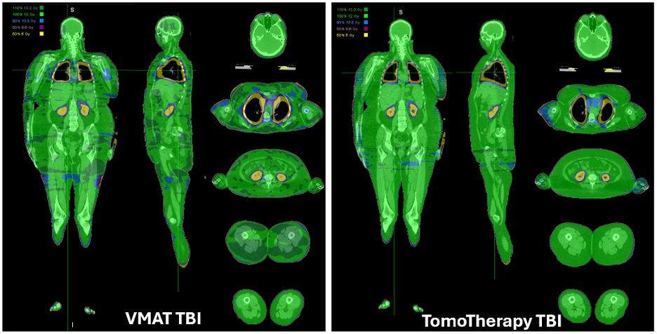 Total Body Irradiation Scan